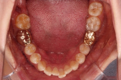 부산치아교정비용