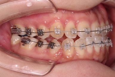 부산치아교정추천