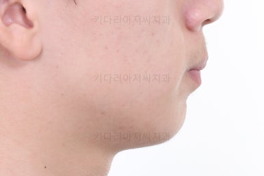 부산청소년치아교정