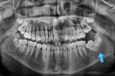 부산연산동사랑니발치
