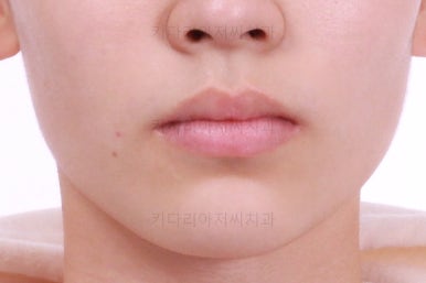 부산연산동치아교정