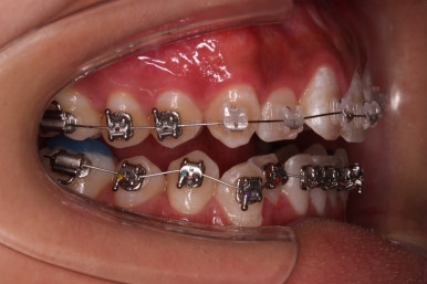 부산치아교정치과