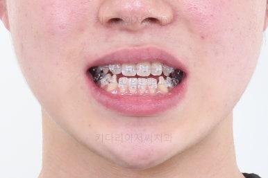 부산주걱턱교정