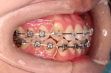 부산치아교정잘하는곳