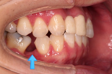 연산동치아교정