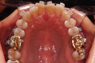 동래임플란트교정