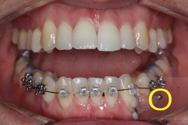 부산비수술교정