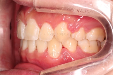 부산돌출입교정