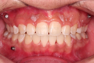 부산청소년치아교정