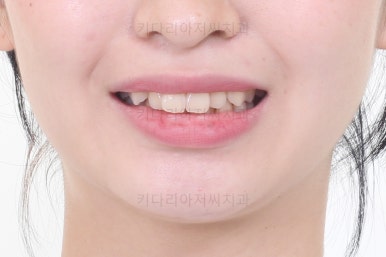 부산돌출입교정