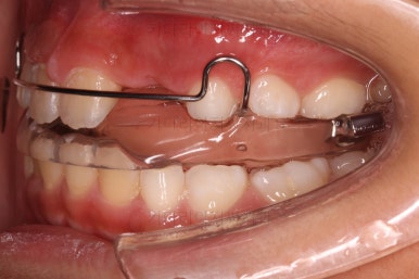 부산어린이돌출입교정