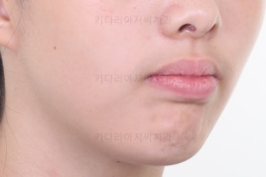부산투명교정
