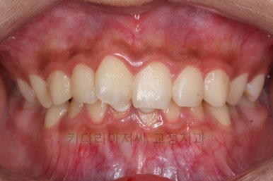 연산동치아교정