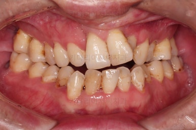 부산구순구개열교정