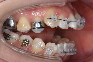 부산개방교합교정