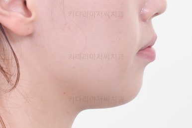 부산비대칭교정