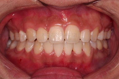 부산청소년치아교정