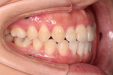 부산비발치교정