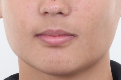 부산연산동치아교정