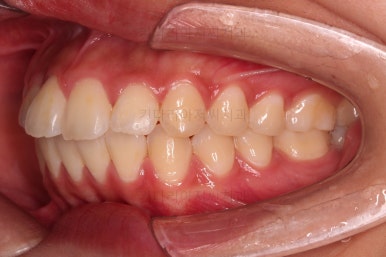 부산연산역치아교정