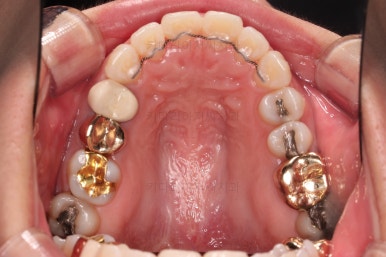 부산부분치아교정