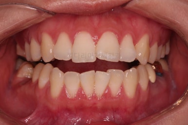 부산사랑니교정