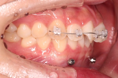 부산앞니부분교정