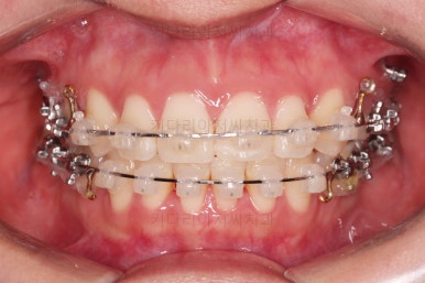 부산사랑니교정