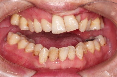 부산구순구개열교정