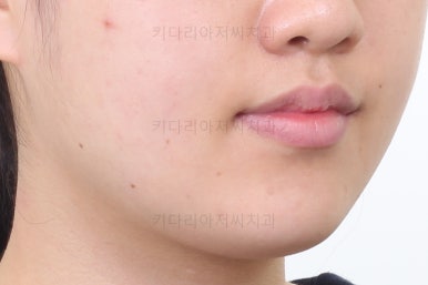 부산비발치교정