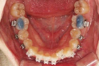 부산돌출입교정