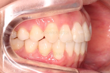 부산교정잘하는치과