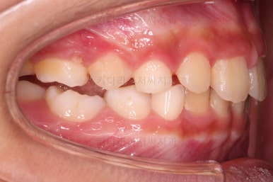 부산어린이돌출입교정