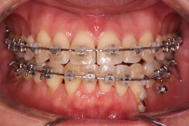 부산비수술교정