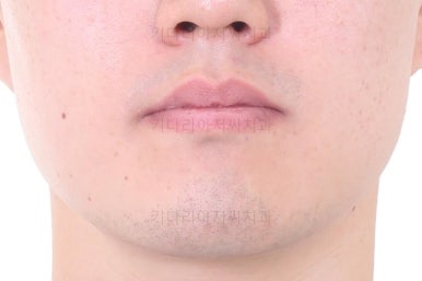 부산비수술교정