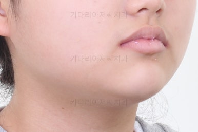 연산동치아교정