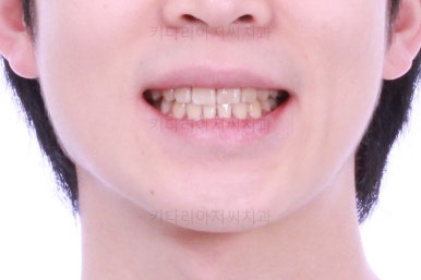 부산돌출입교정