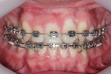 부산구순구개열
