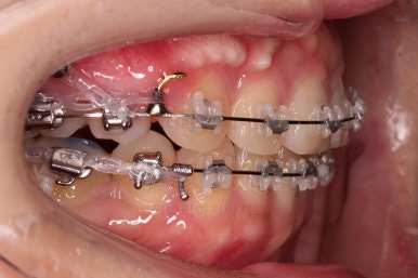 부산연산동교정치과
