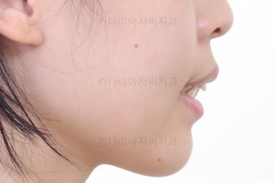 부산클리피씨교정