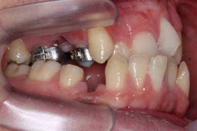 부산구순구개열