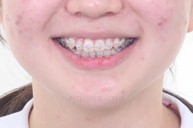 부산치아교정잘하는곳