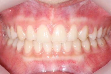 부산매복치아교정