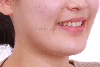 부산치아교정