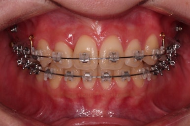 부산돌출입교정
