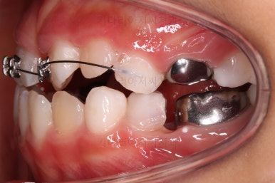 부산어린이반대교합