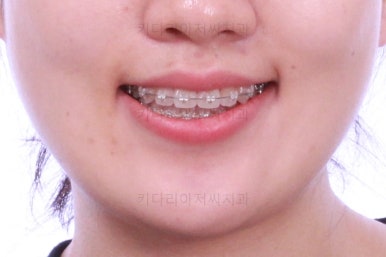 부산비발치교정