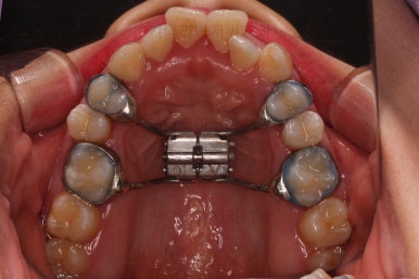 부산비발치교정