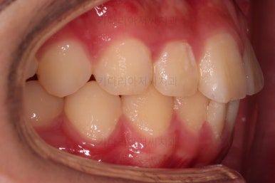 부산연산동사랑니발치