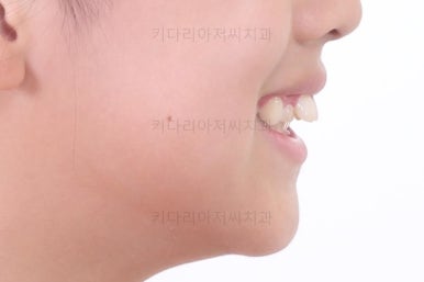 부산토끼치아교정